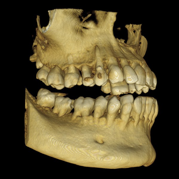 3D Imaging example of a mouth 