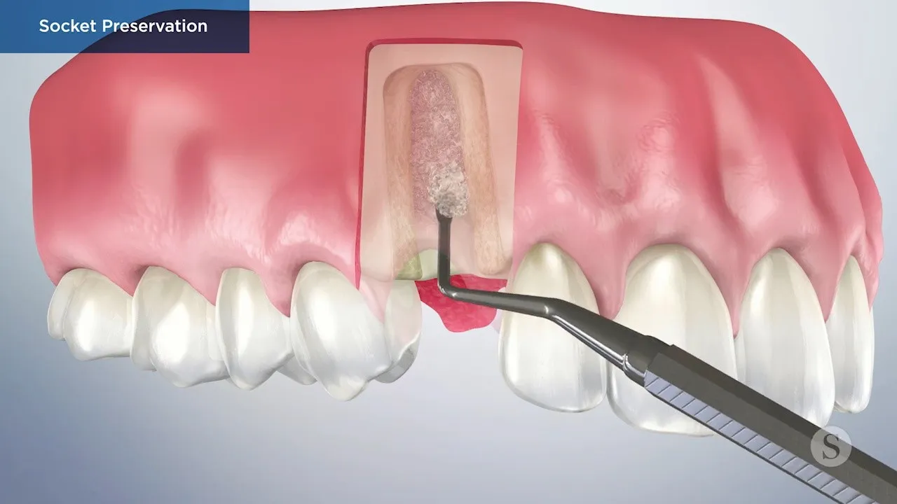 Bone Graft Socket Prevention Video Thumbnail
