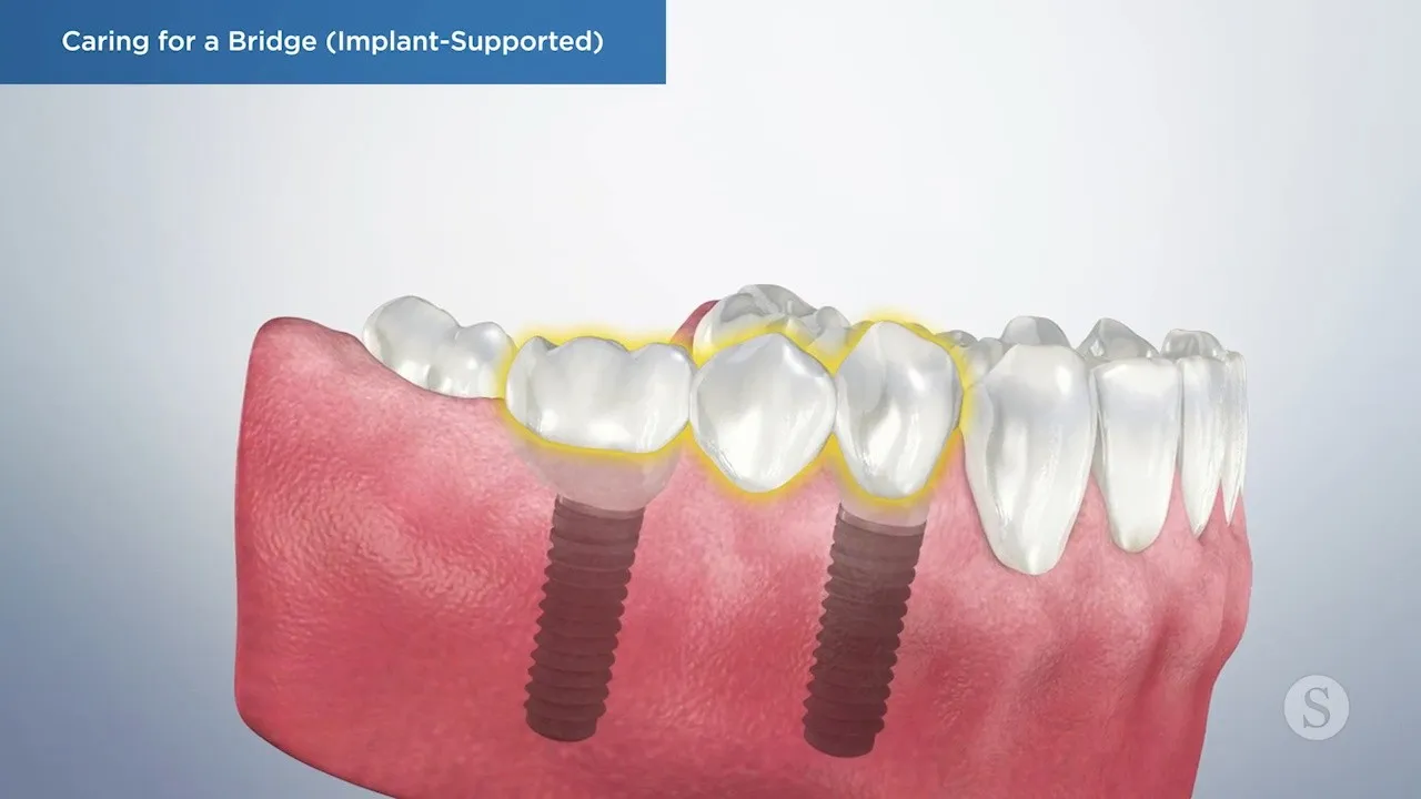 Caring for a Bridge Implant Supported Video Thumbnail
