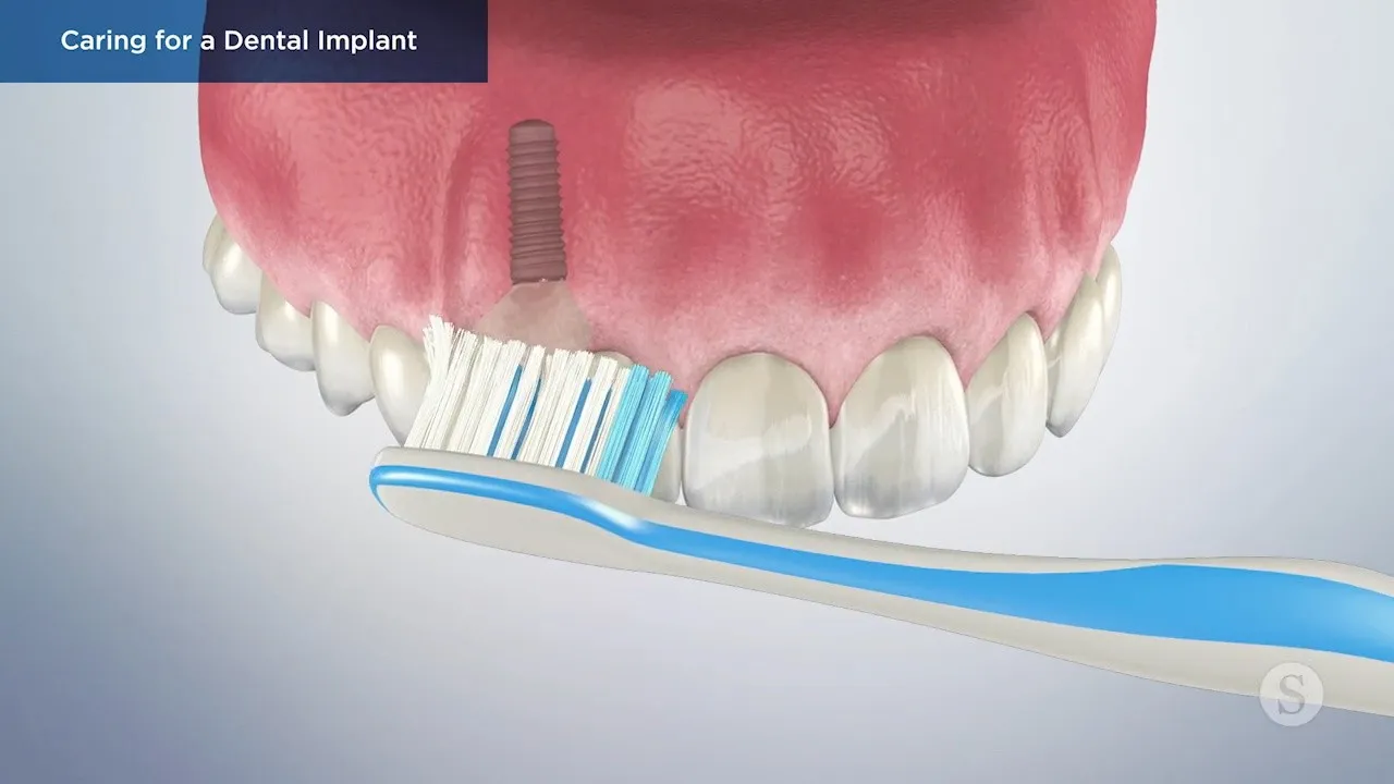 Caring for Dental Implants Video Thumbnail