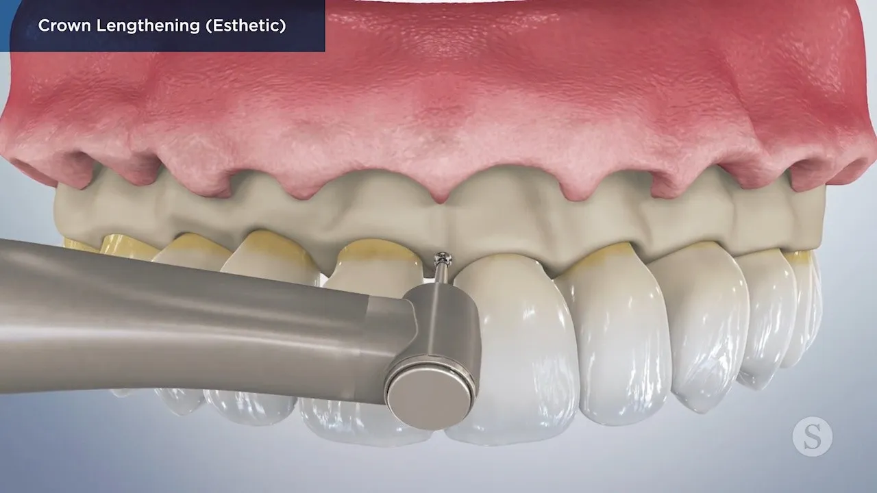 Crown Lengthening Video Thumbnail