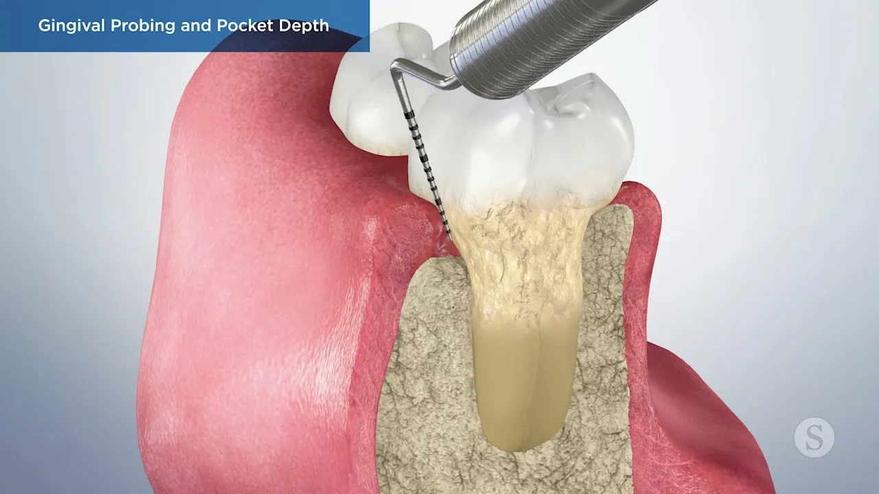 Gingival Probing Video Thumbnail
