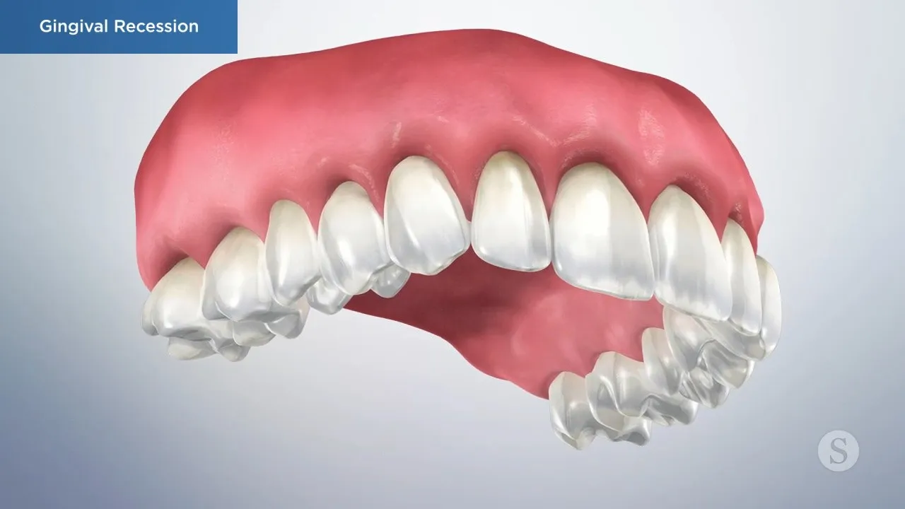 Gingival Recession Video Thumbnail