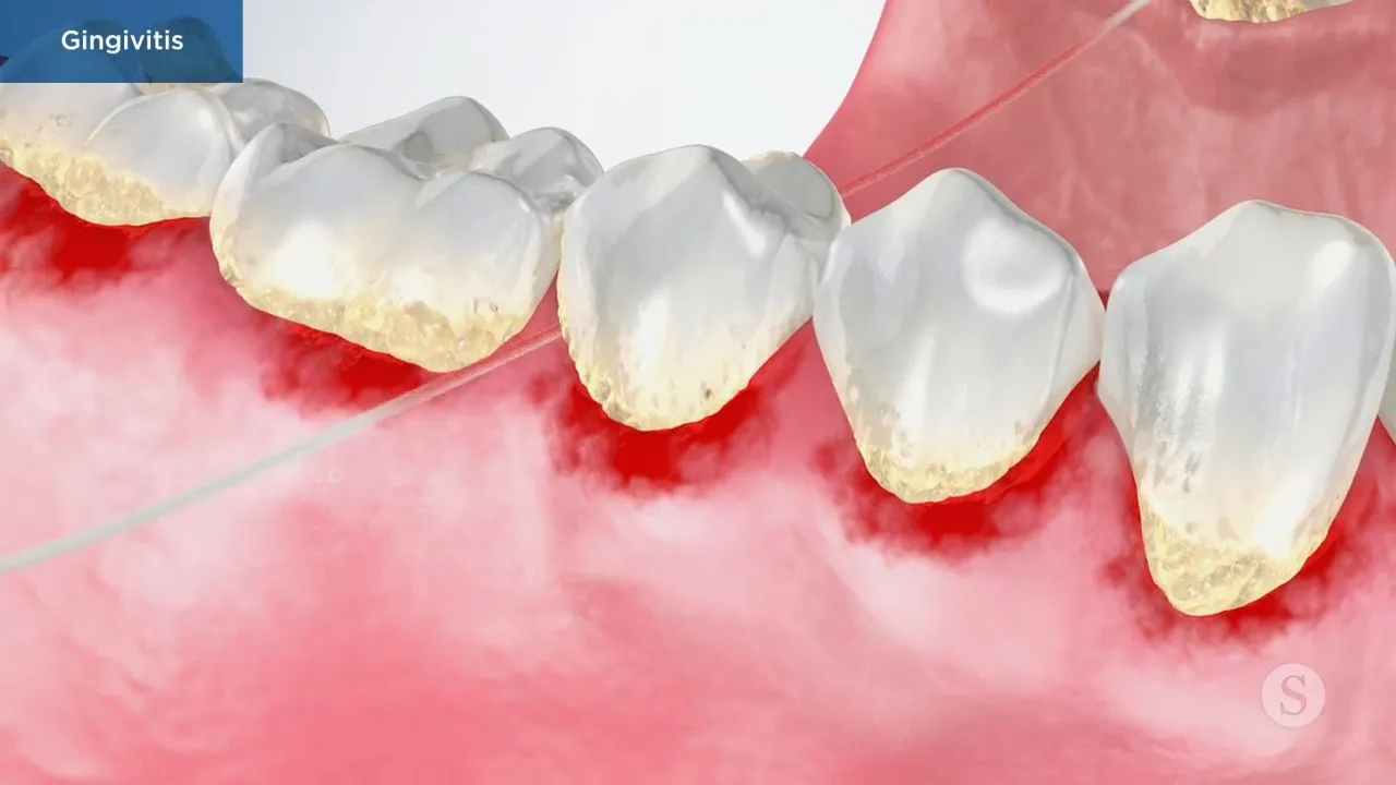 Gingivitis Video Thumbnail