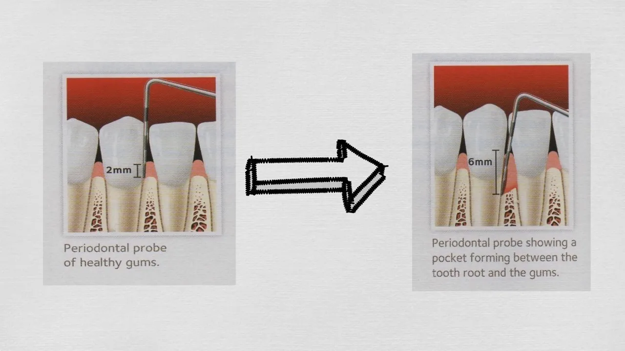 Periodontal Disease Video Thumbnail