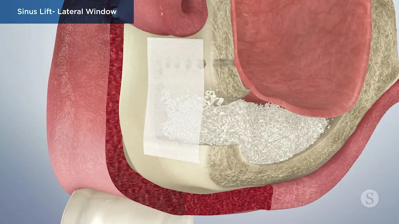 Sinus Lift Lateral Window Video Thumbnail